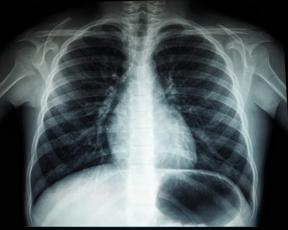 우리는 흉부 X-ray 촬영과 같이 일상에서도 피폭을 경험한다. (사진=언스플래쉬(unsplash))